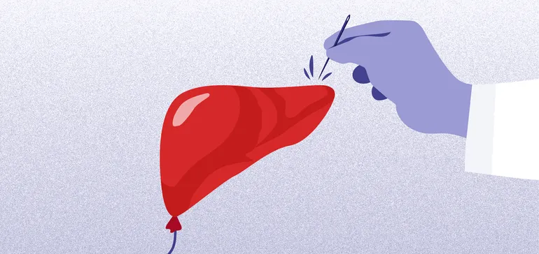 Liver Biopsy: A Potential Bottleneck in the Expansion of the NASH Drug Market?