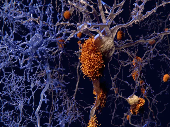 Amyloid's last hope? Prevention studies next big test for Alzheimer's research